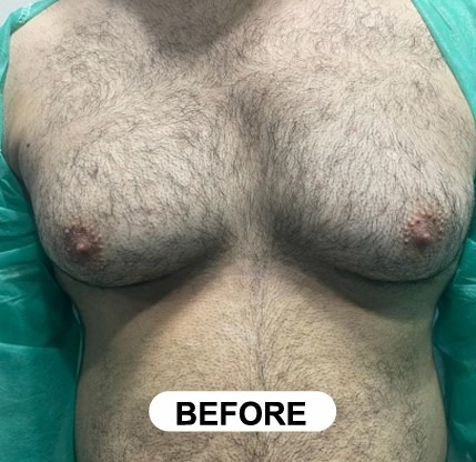 Before Gynecomastia Surgery